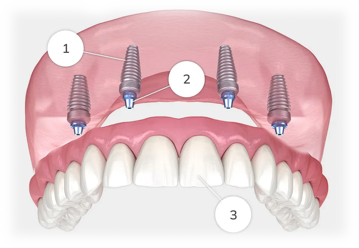 Fixed implant diagram