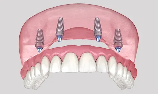 Fixed implant