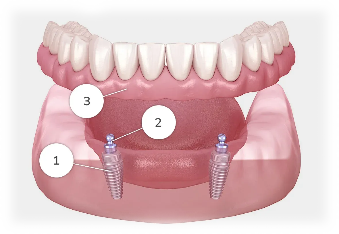 Implant supported denture diagram