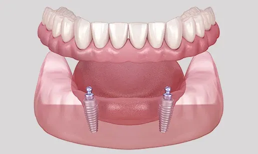 Implant supported denture