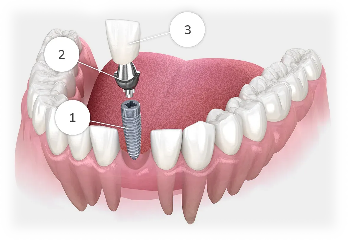 Single implant diagram