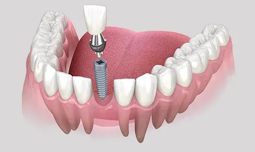 Single implant